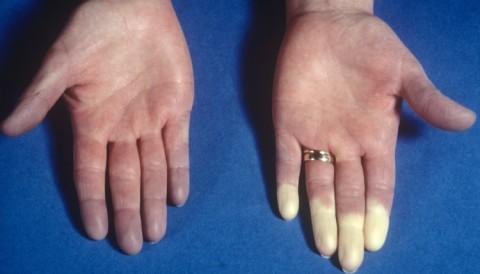 example of raynauds